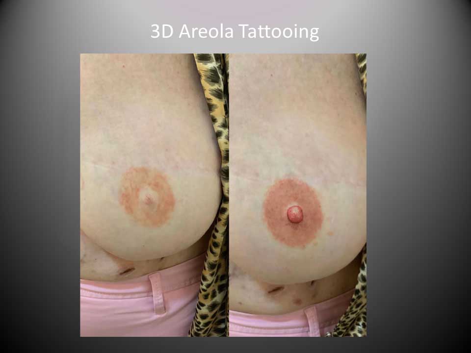 3d areola tattooing