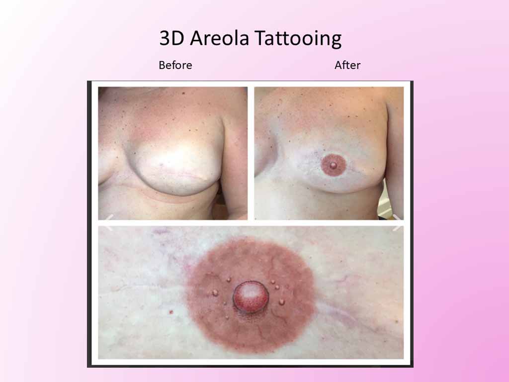 3D Areola Tattooing