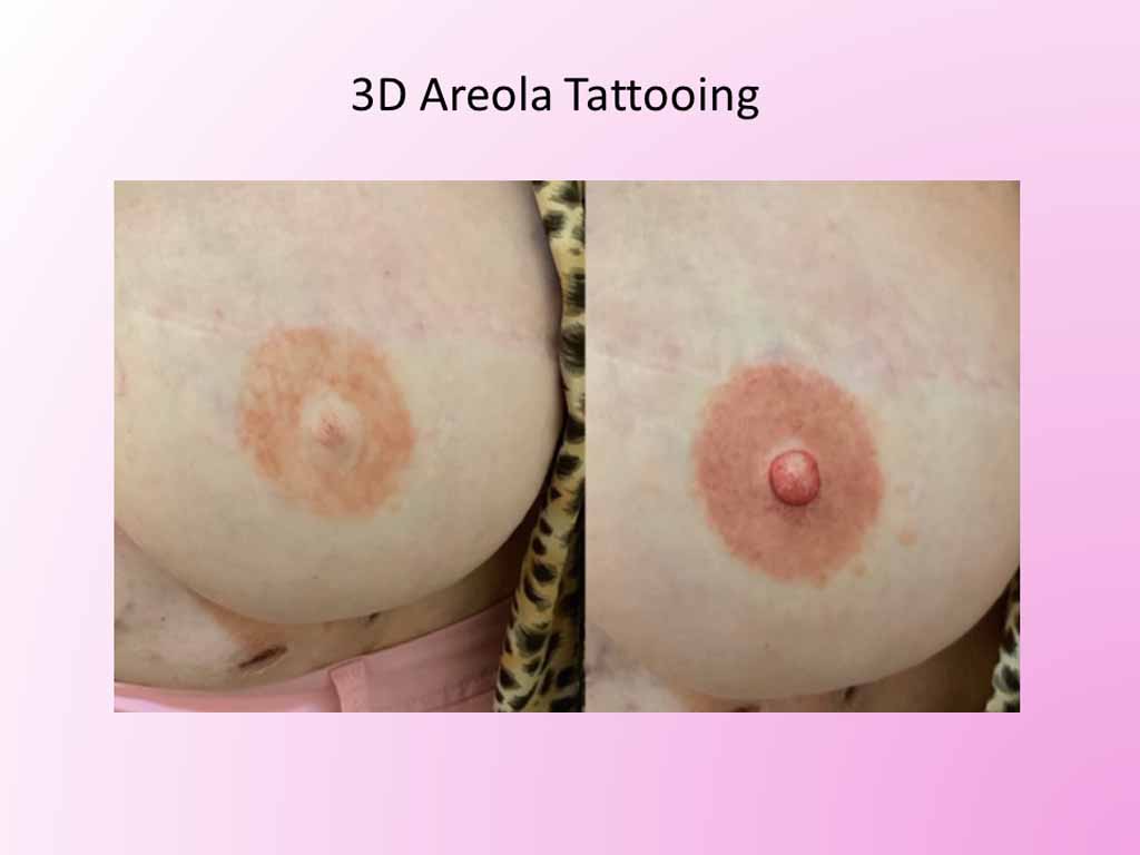 3D Areola Tattooing