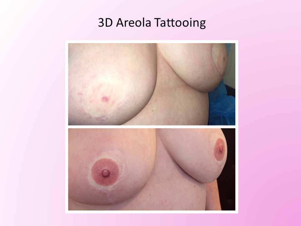 3D Areola Tattooing