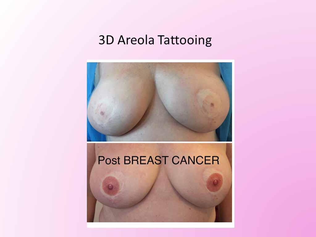 3D Areola Tattooing