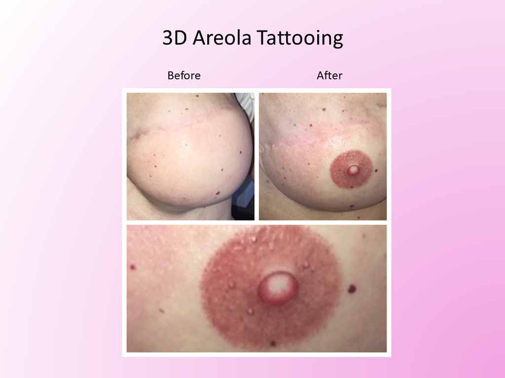 3D Areola Tattooing