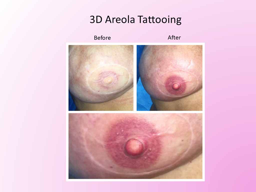 3D Areola Tattooing