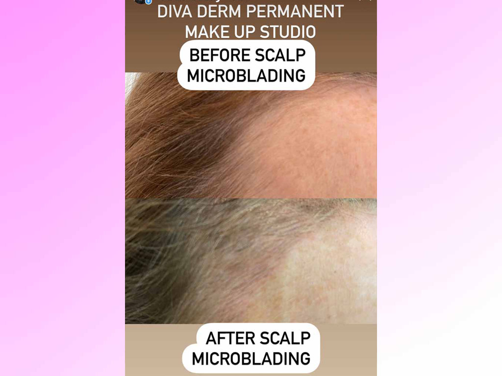 Scalp Micropigmentaion - female