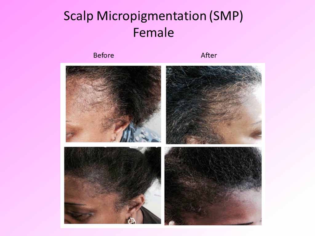 Scalp Micropigmentaion - female