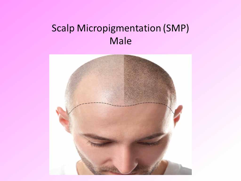 Scalp Micropigmentaion - male