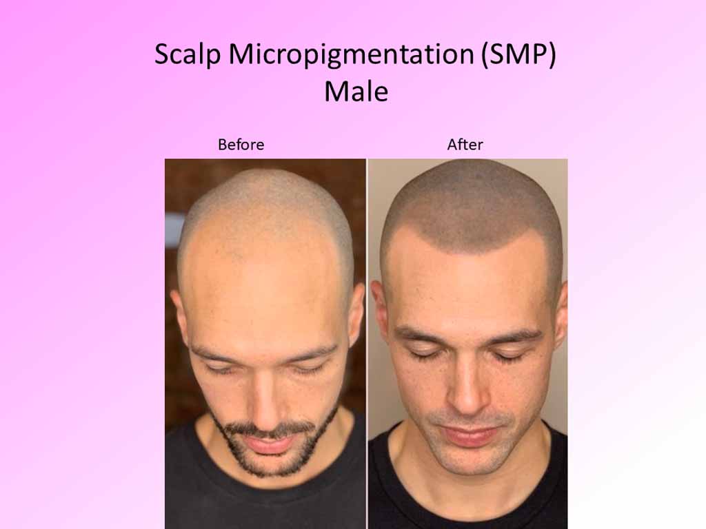 Scalp Micropigmentaion - male