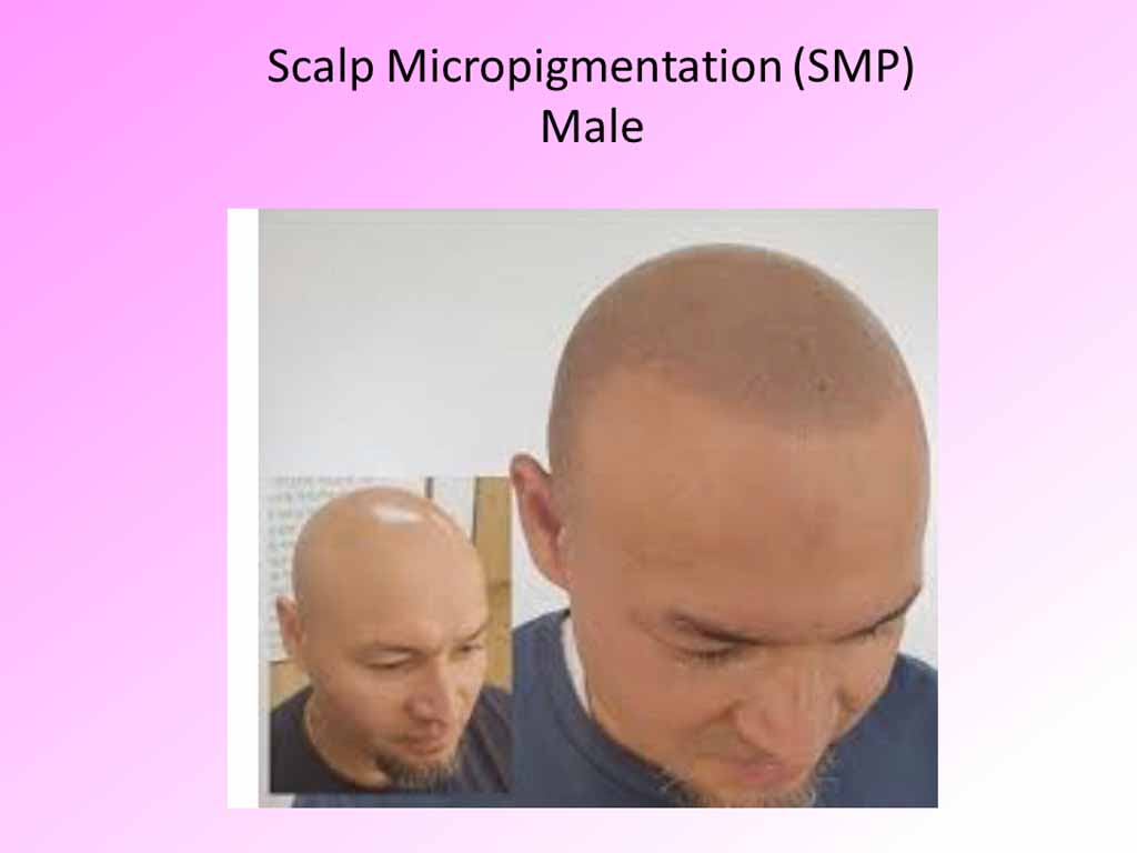 Scalp Micropigmentaion - male