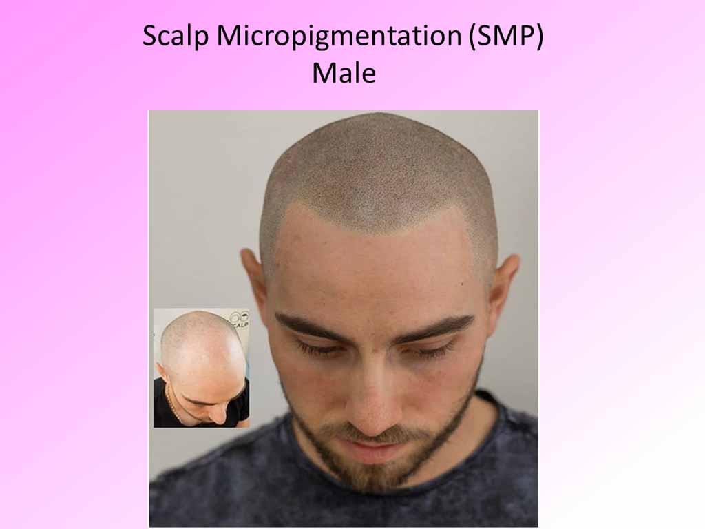 Scalp Micropigmentaion - male