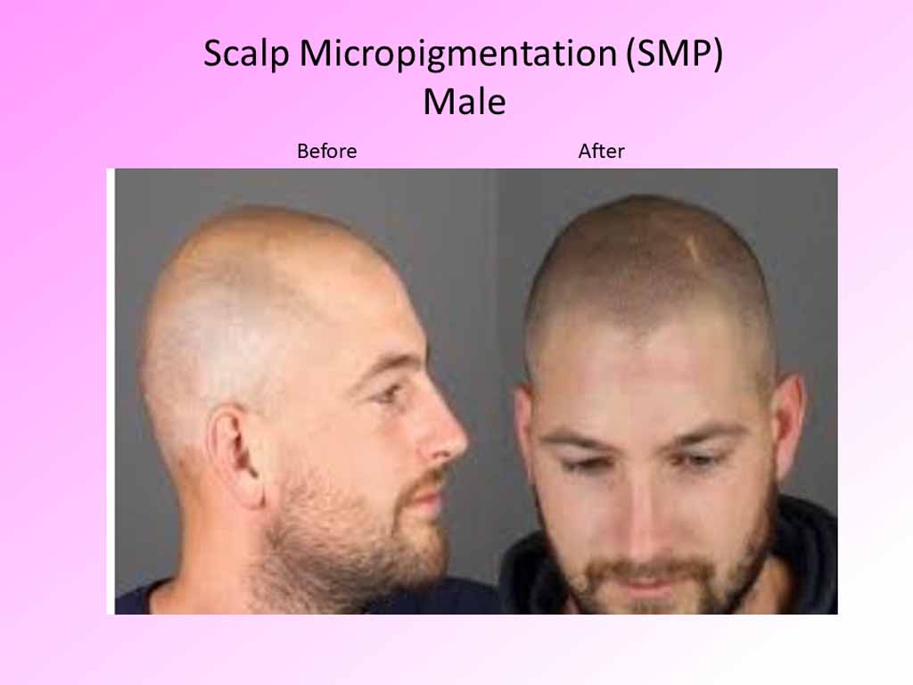 Scalp Micropigmentaion - male