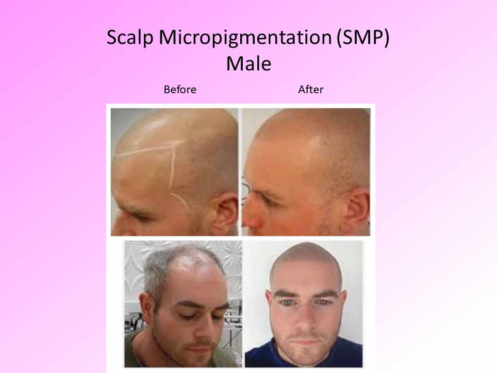 Scalp Micropigmentaion - male