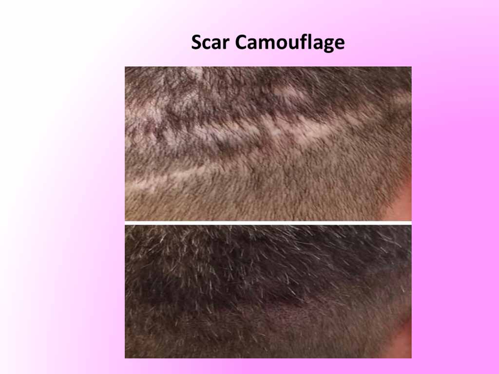 scar-camouflage