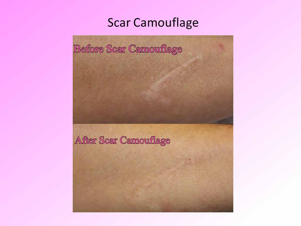 scar-camouflage