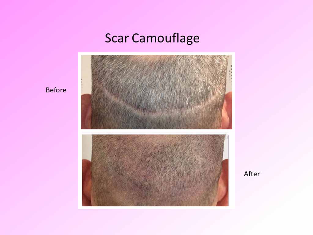 scar-camouflage