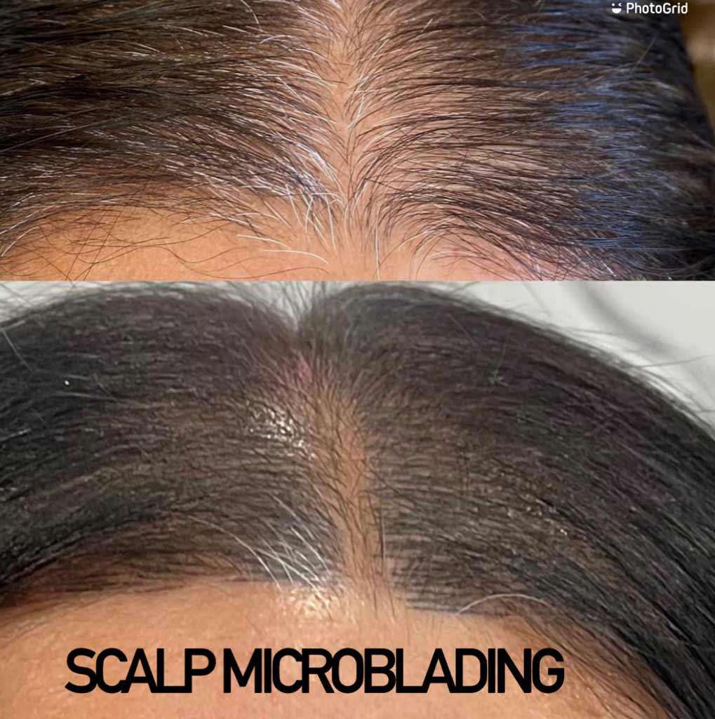 Scalp Microblading